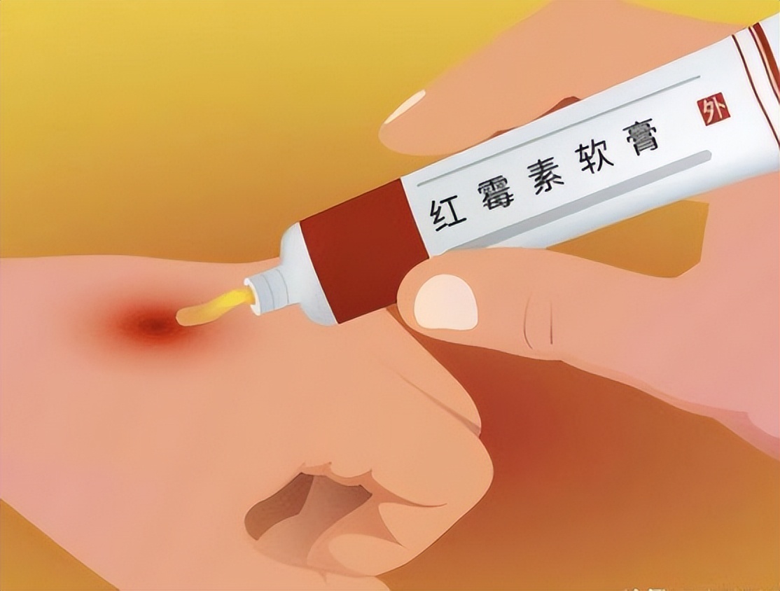红霉素软膏都能治什么,红霉素和金霉素软膏的作用和功效