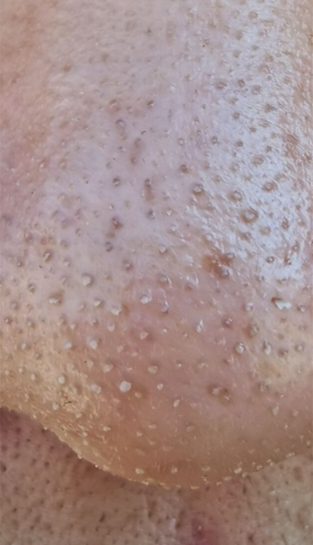 清洁面膜可以去黑头粉刺闭口吗,清洁面膜可以去除黑头吗