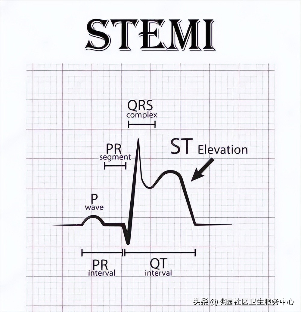 后循环梗死的识别,梗死分为哪三大类型