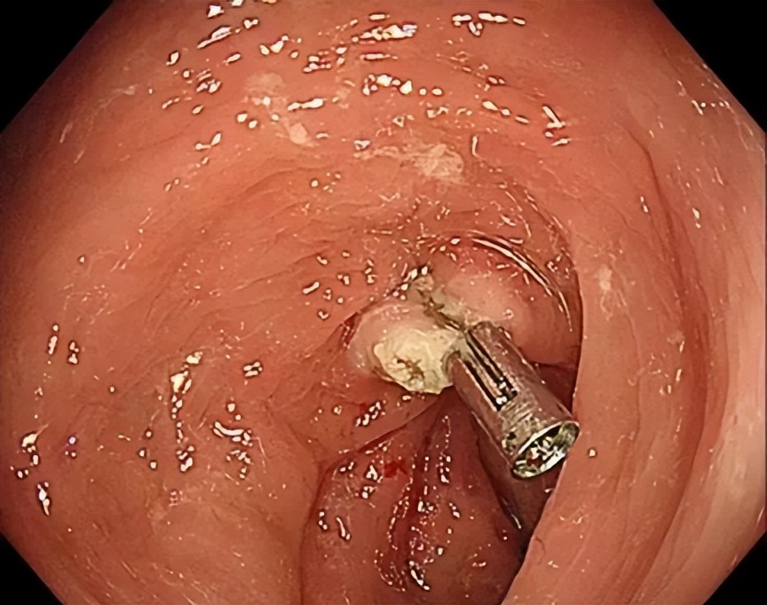 胃肠息肉切除后需要注意什么,胃肠息肉切除后应该注意什么