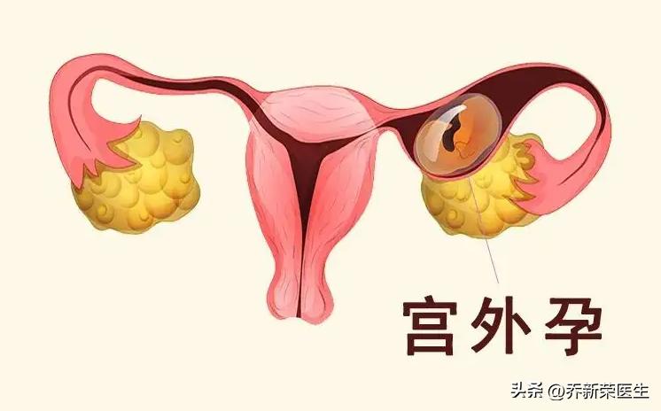 输卵管宫外孕术后还能怀孕吗,宫外孕开窗取胚术后自然怀孕