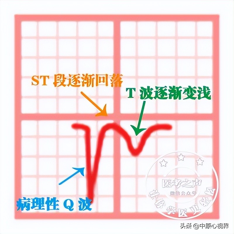 护考几种常见的心电图,常见的心电图图形分析