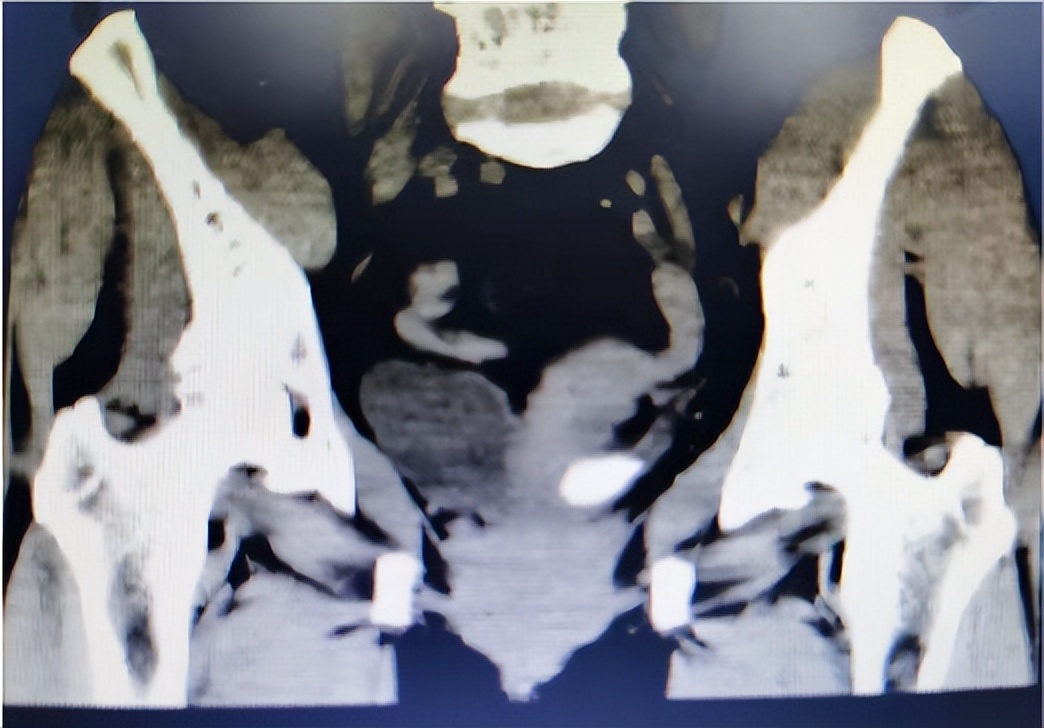 结石堵在泌尿管很痛怎么办,结石引起的尿路堵塞吃什么药