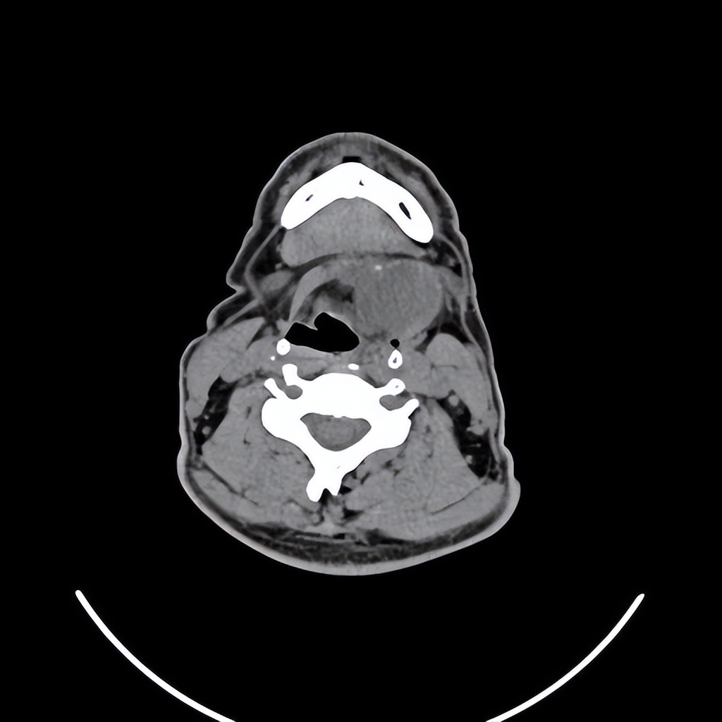 颈部有肿块不痛不痒严重吗,颈部肿物恶性的可能大吗