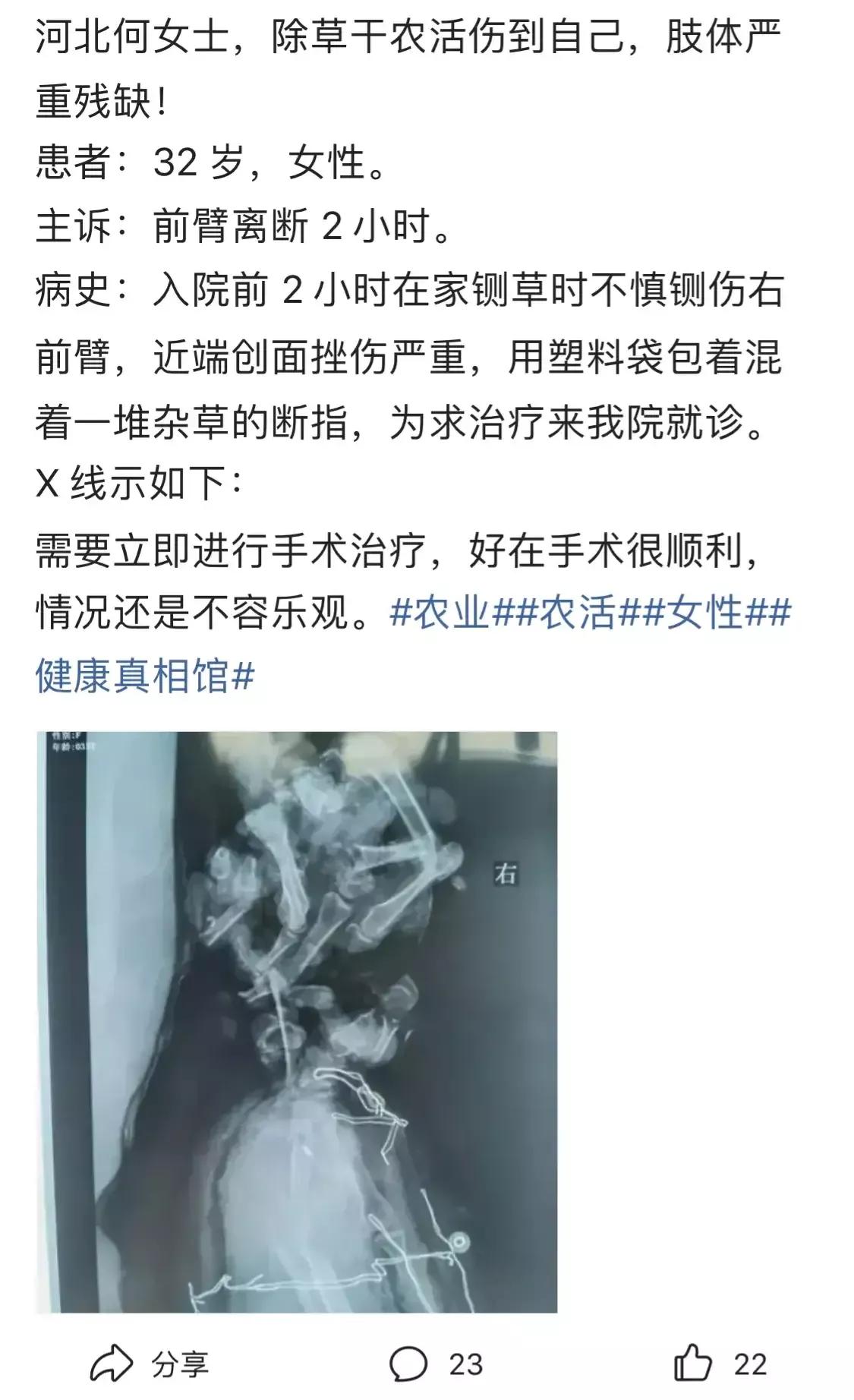 手被人砍了是民事还是刑事责任,手被砍到什么情况才算重伤