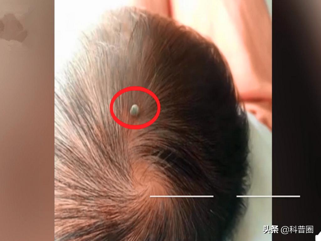 致命蜱虫,比蜱虫还可怕