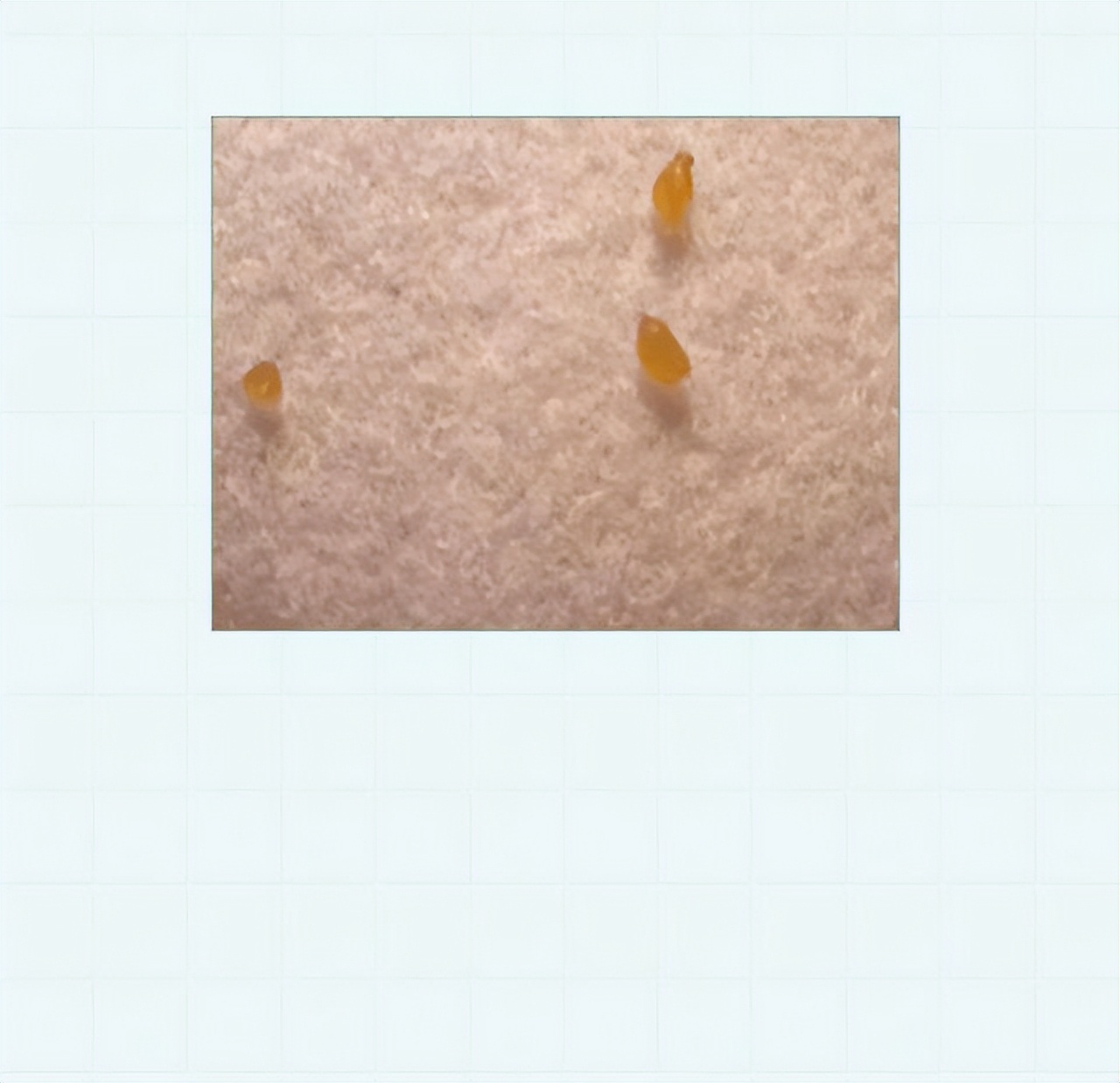 头皮上的白色颗粒,头皮上的白色颗粒是虱子吗