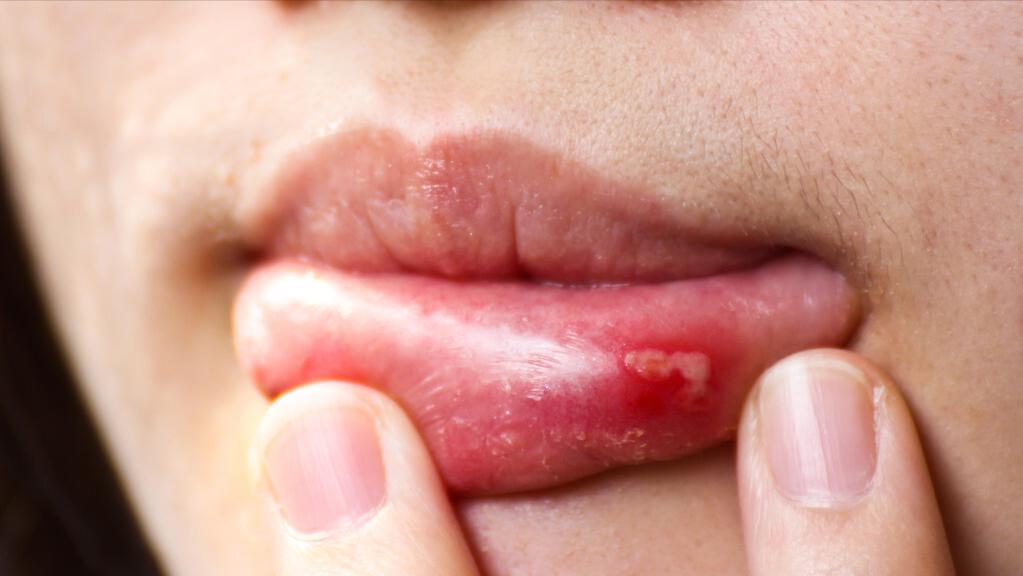 艾滋病早期口腔溃疡有什么症状,口腔溃疡是艾滋病前期典型症状吗