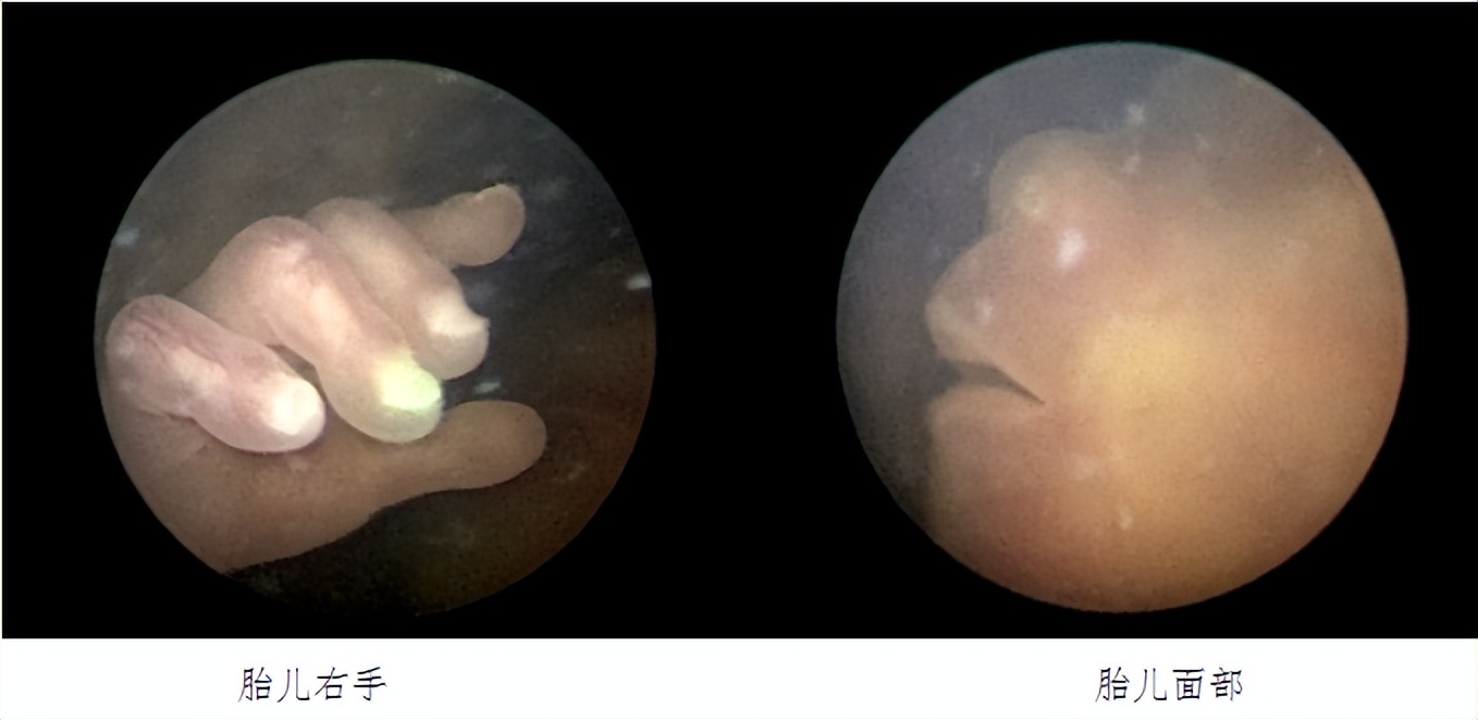 国内首例胎儿宫内手术,妇幼保健院首例阴式切除手术