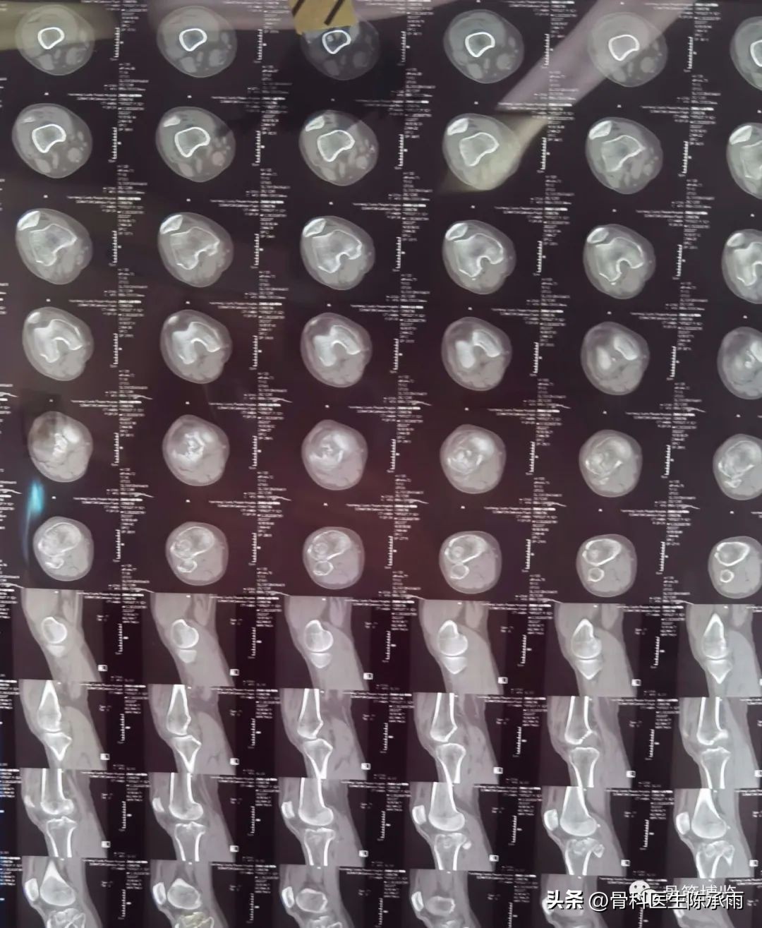 膝关节胫骨平台骨折,最近胫骨平台骨折视频