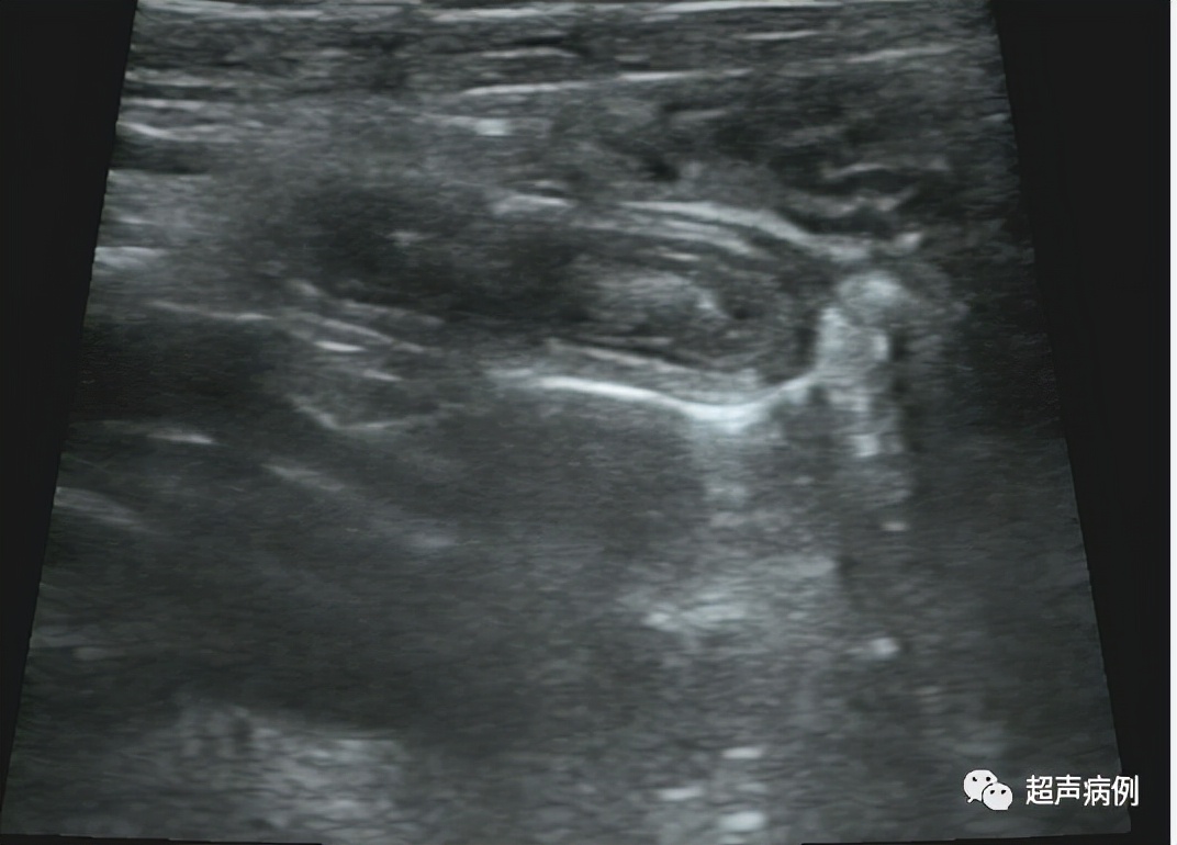 阑尾炎超声下怎么看？哪些知识需要掌握？这里都总结好了