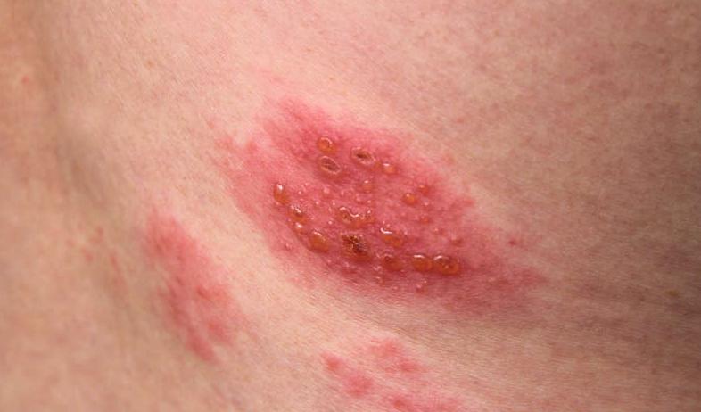 带状疱疹又叫“缠腰蛇”，该怎么治？医生：这10类人易被盯上！