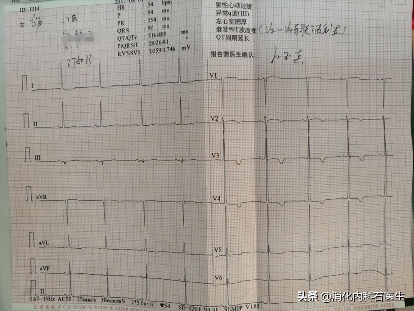 90岁老人心梗介入治疗危险吗,老人急性心梗手术