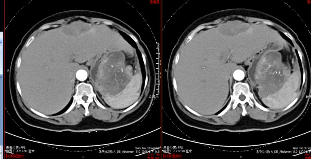 腹部鼓包是什么病,上腹部有包块伴有腹胀怎么回事