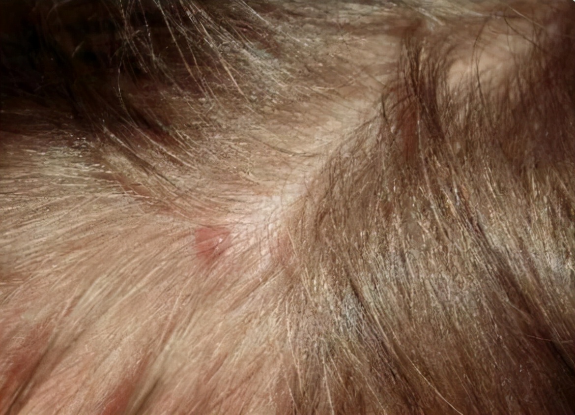 头皮有疙瘩脓包痒痒用什么药,头皮起红色小疙瘩有脓包怎么治