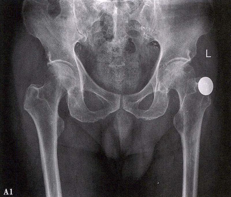 全国十大股骨头坏死诊疗中心,股骨头坏死诊疗方法有哪些