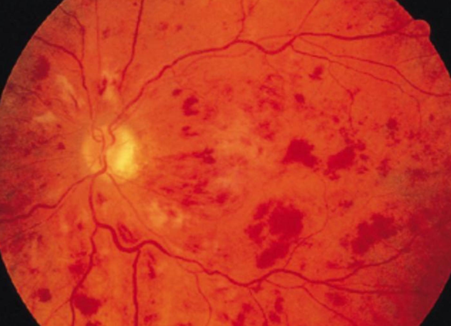 糖尿病患者出现视力模糊是怎么回事？如何应对？早了解早预防