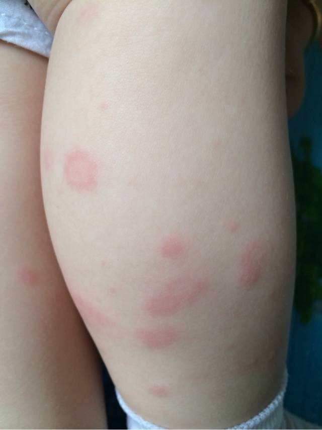 孩子荨麻疹痒得受不了怎么办,荨麻疹痒得不行了怎么办