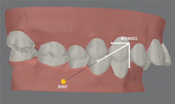 正畸隐形矫正皮筋怎么挂,正畸隐形牙套牵引作用