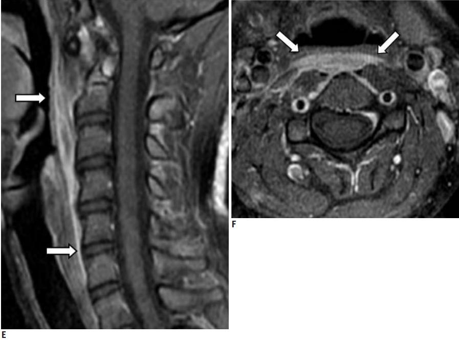 颈长肌腱炎影像表现,三头肌钙化性肌腱炎治疗