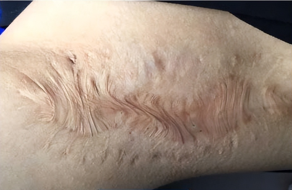 烧烫伤疤痕与硬损伤性疤痕的区别,烫伤疤痕好了可以用芦荟祛疤痕吗