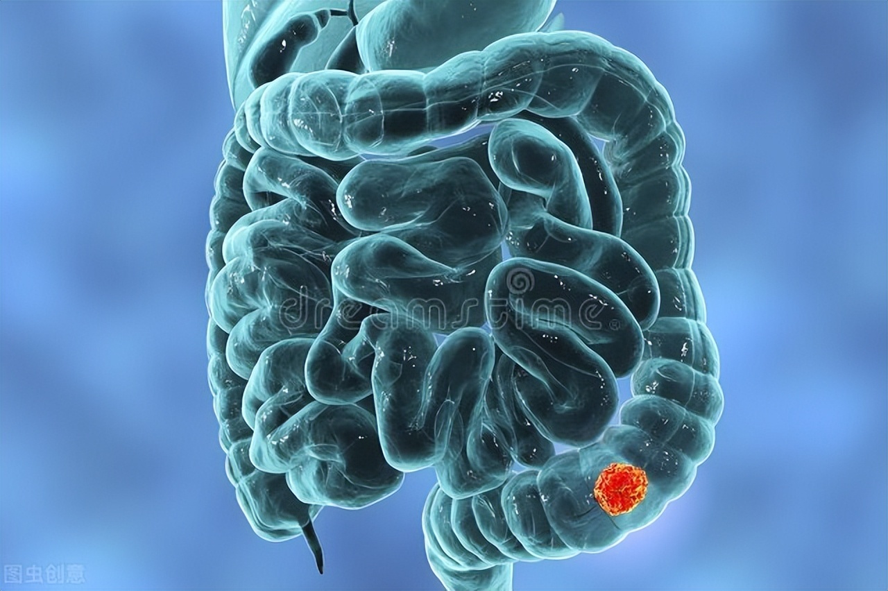 屁多是肠癌的信号吗,肠鸣是肠癌的早期信号吗