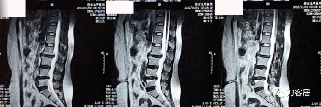 感染新冠左侧腰腹抽痛,腿酸疼是新型冠状病毒怎么治疗