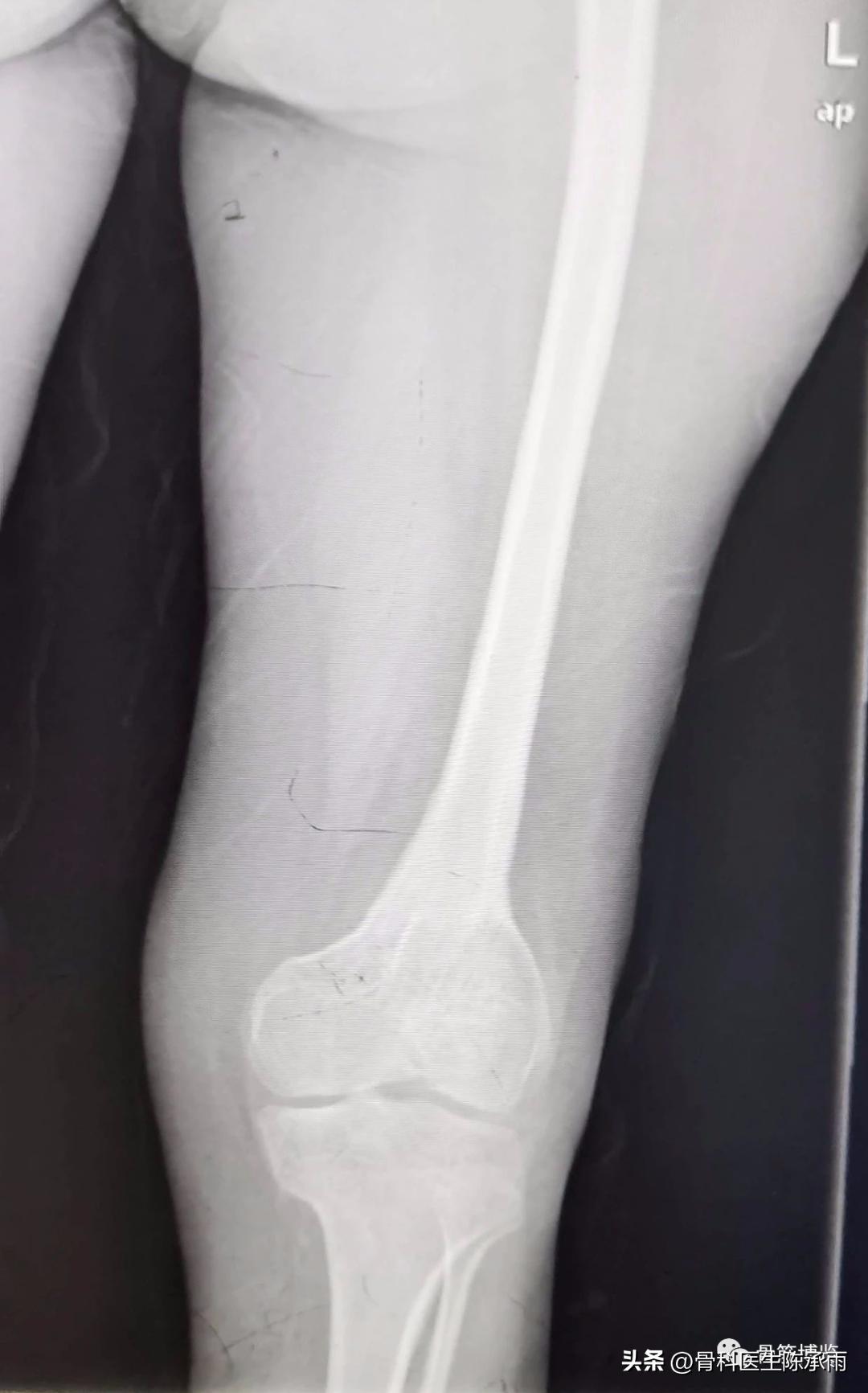 股骨颈闭合复位内固定术后护理,股骨颈骨折闭合复位的技巧