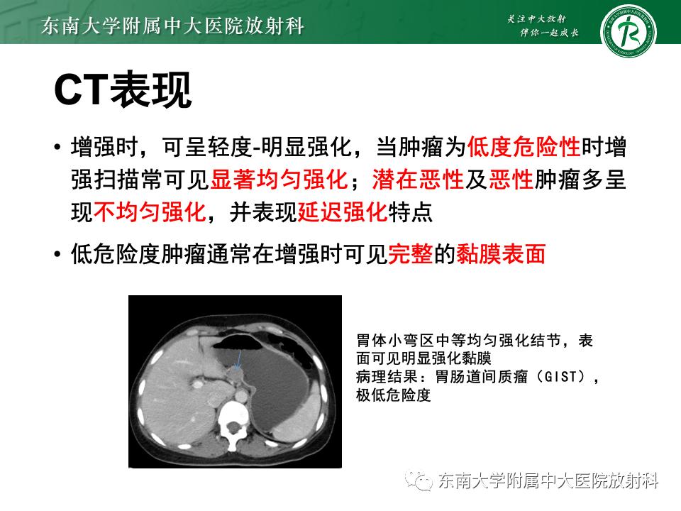 小肠间质瘤最新治疗中药方,小肠间质瘤基因检测