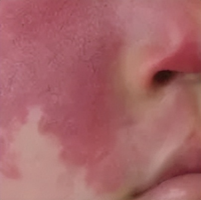 新生儿有胎记,新生儿身上有胎记怎么处理