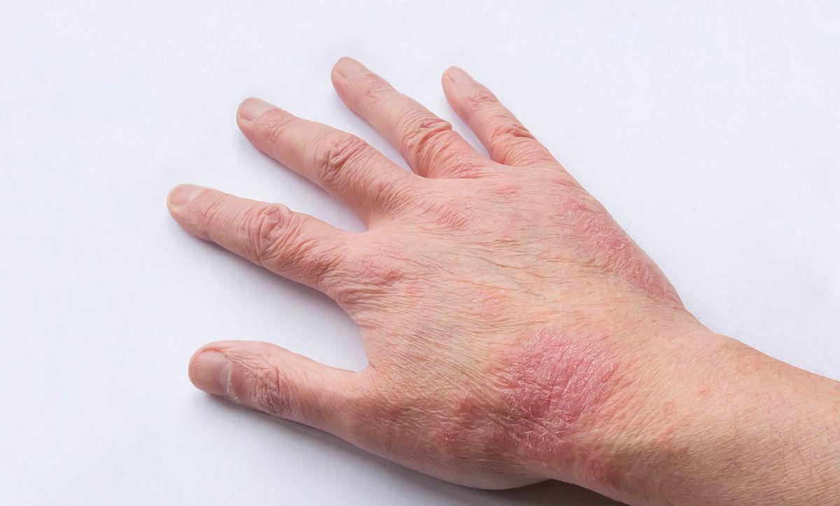 湿疹抓痒后严重,湿疹用999皮炎平更痒了怎么回事