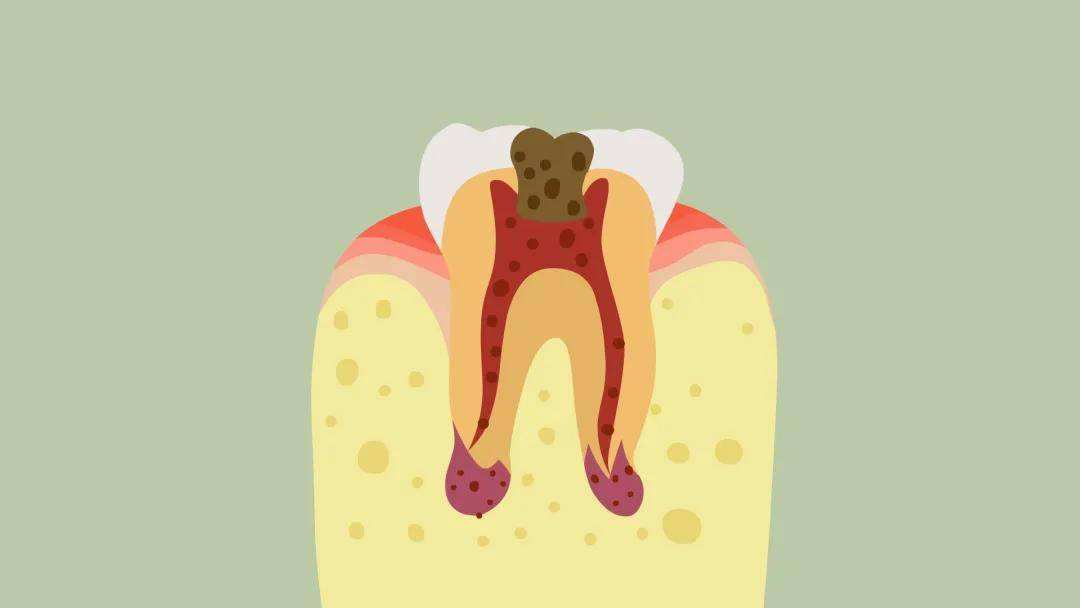 备孕会不会出现牙疼,牙出现大洞牙疼怎么办