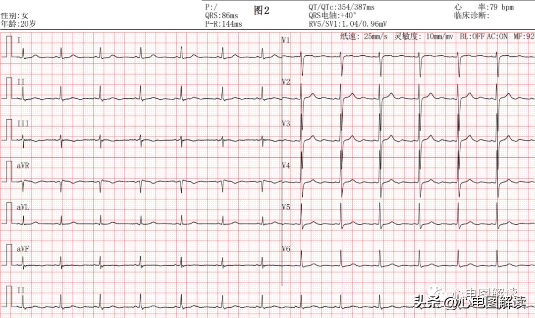 心电图会误诊冠心病吗,心电图会误诊心肌梗死吗