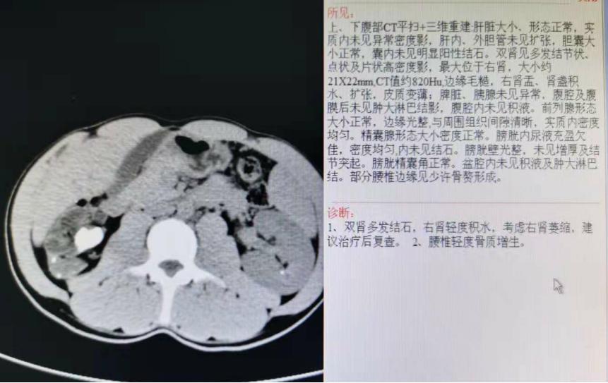 左肾萎缩右肾轻度积水还会萎缩吗,肾结石久拖不治