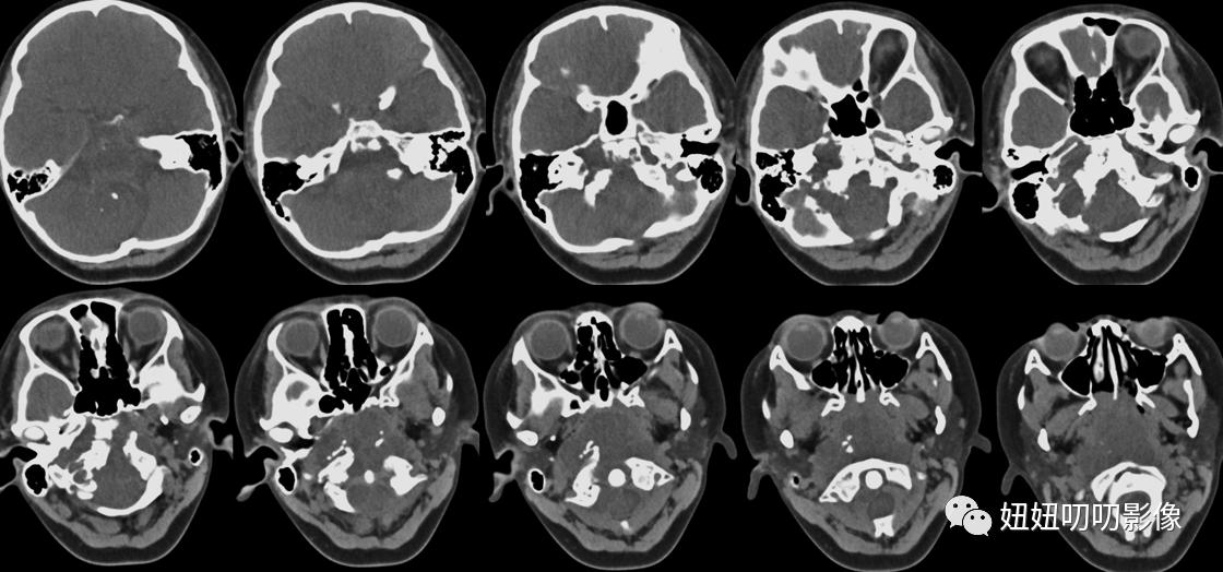 脊索瘤核磁表现,颅底ct头颅ct啥区别