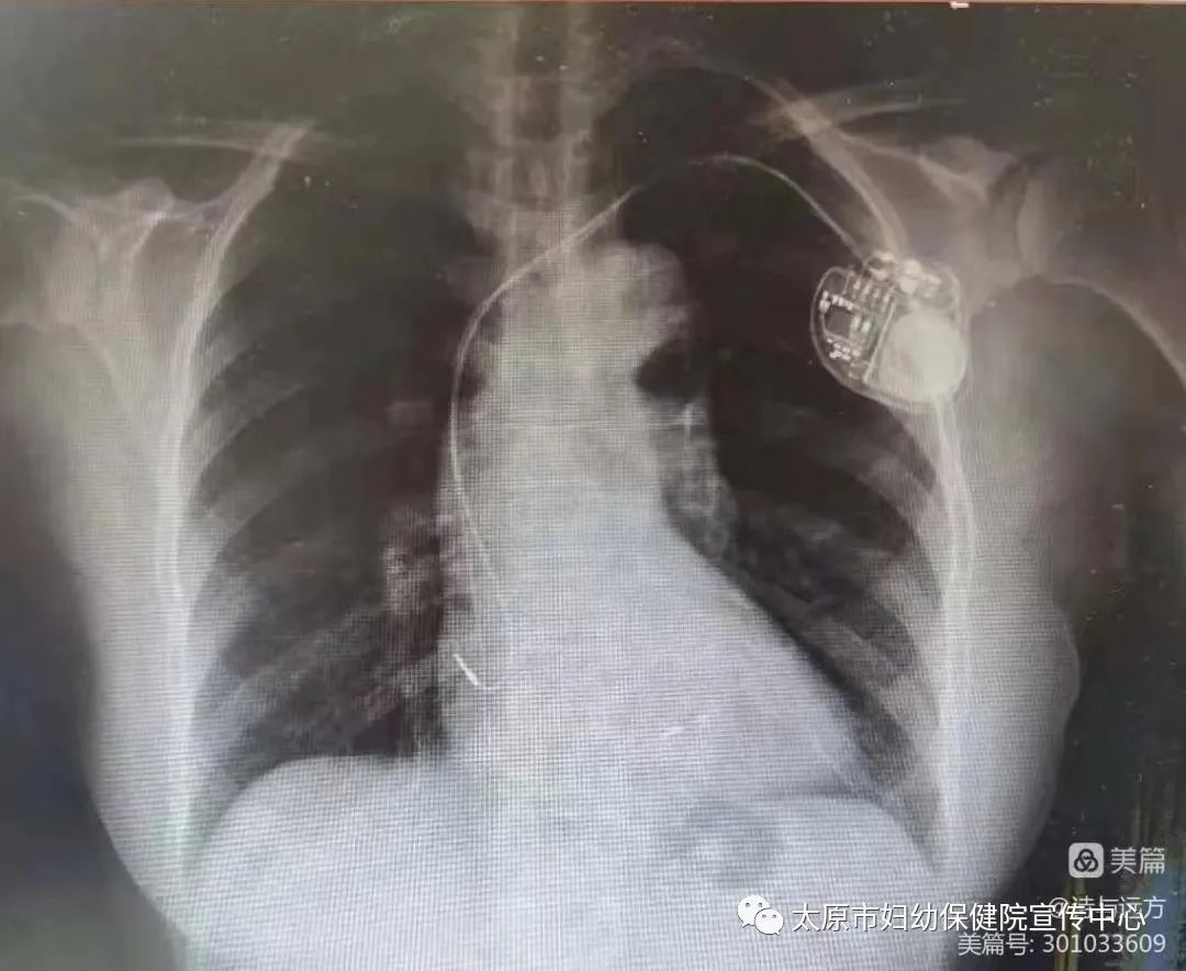 心脏起搏器植入山西哪家医院好,太原市心血管医院心脏起搏器