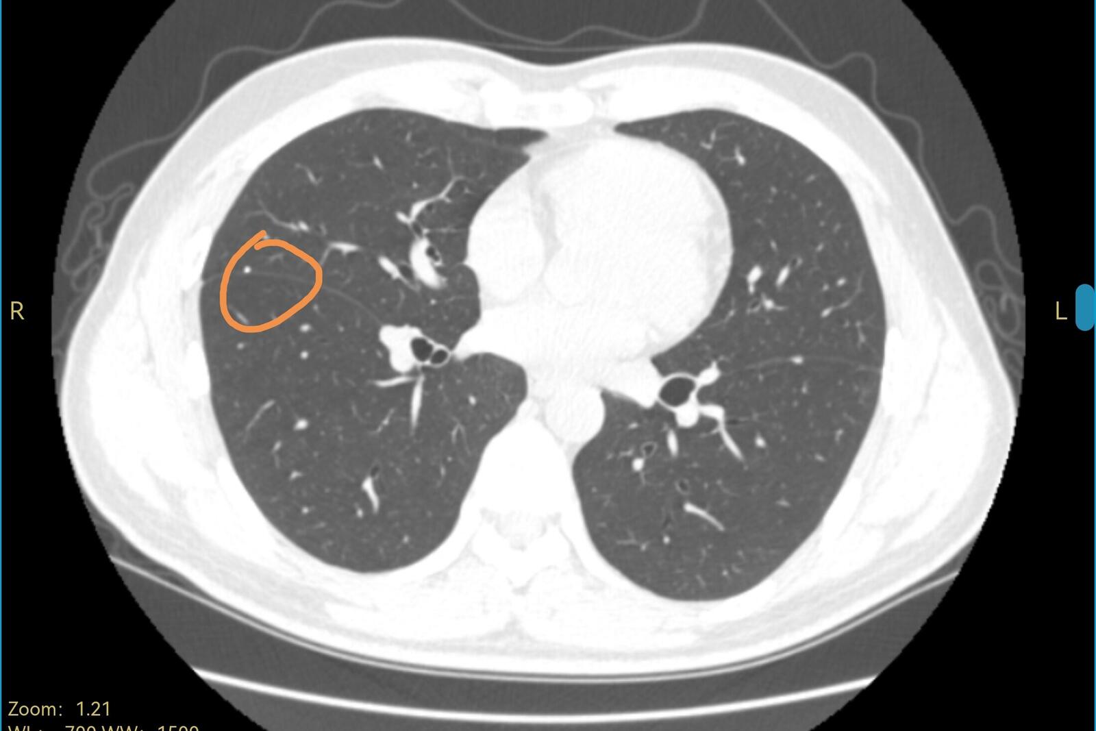 刘懿博士说肺癌的书,刘懿博士说肺癌全集