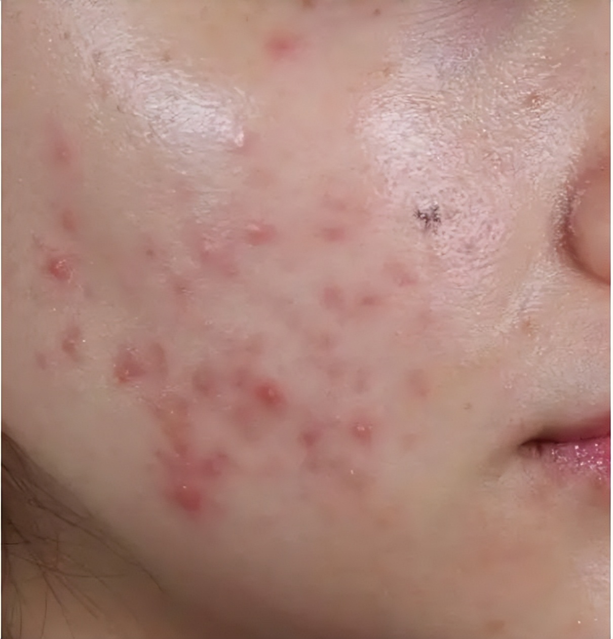 痘痘肌肤怎么形成的,痘痘肌肤问题及解决方法