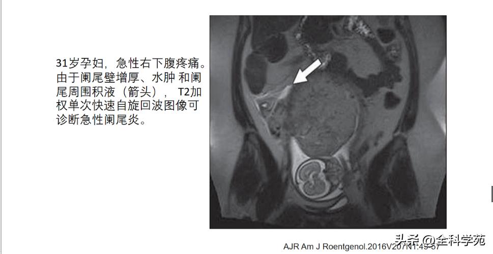 阑尾炎的讲解,关于阑尾炎的讨论总结
