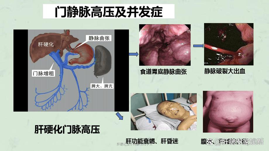 治肝硬化肝病最好的中医,肝硬化喝中药活血化瘀的表现