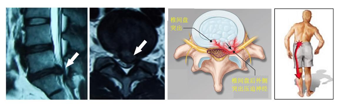 医学科普腰痛的原因 (健康医学科普知识腰痛)