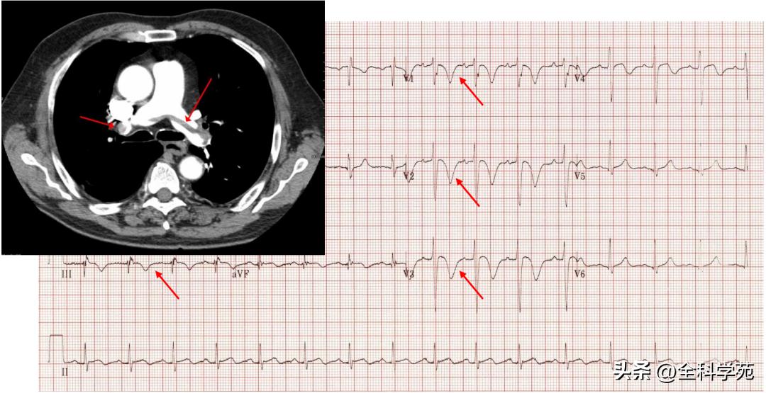 t波倒置三种常见原因,t波低平倒置有事吗