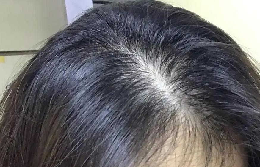 女生预防掉发的方法,女性掉发的原因如何杜绝掉发
