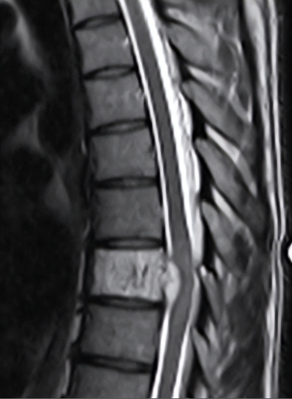 s2椎体内血管瘤属于浅表血管瘤吗,椎体血管瘤有恶性的吗需要穿刺吗