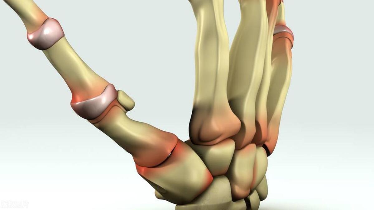 年轻女孩子得类风湿怎么办,预防老年类风湿性关节炎良方妙法