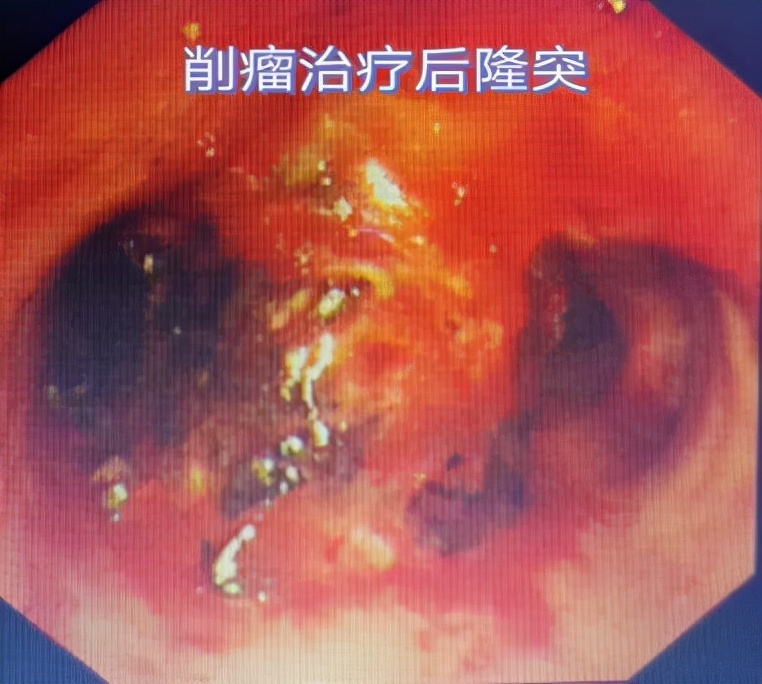 哈医大一院气管镜,哈医大群力呼吸内科