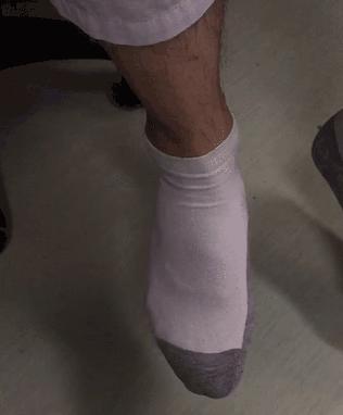 足内翻容易崴脚,足内翻多走路锻炼能减轻吗