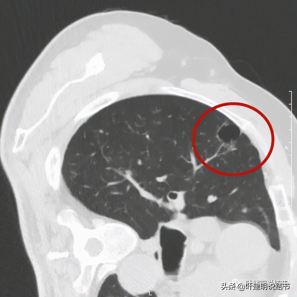 肺多发结节切除一个剩下的怎么办,无限纠结的肺小结节