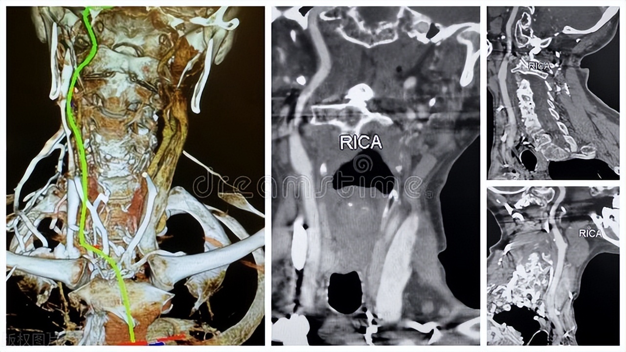 颈动脉斑块6.1x1.8mm要吃药吗,颈动脉斑块7.9x1.9mm需要吃药吗