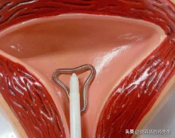 20岁失足少女，采取“上环”避孕措施竟怀孕，就因为1点没注意